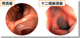 胃潰瘍と十二指腸潰瘍